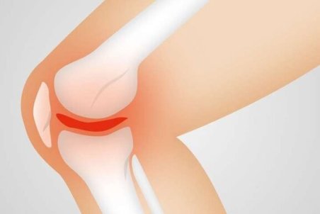 علت دردهای متعدد افراد مبتلا به آرتروز زانو چیست؟