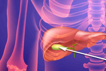 سنگ کیسه صفرا چه علائمی دارد؟