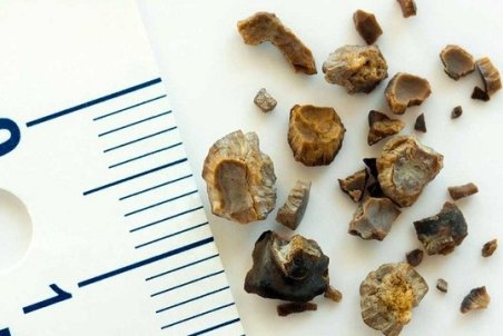 5 روش ساده برای پیشگیری و درمان سنگ کلیه