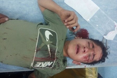 چشم مانی هاشمی کولبر ۱۴ ساله عمل شد