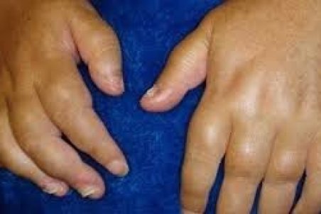 چرا دست ها ورم می کنند؟