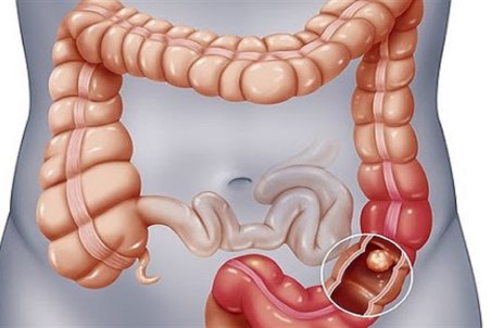 سرطان روده بزرگ دومین سرطان شایع در دنیا