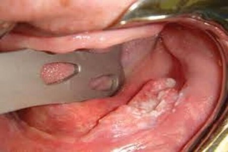 سرطان های دهان، جزء ۱۰ سرطان شایع بدن