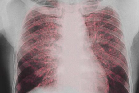 سارکوئیدوز چیست و چه علائمی دارد؟