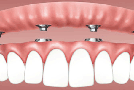 دندان مصنوعی با پایه ایمپلنت و مزایای آن
