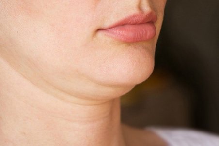 راه‌های درمان غبغب