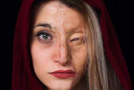 داغ فراموشی پرونده قربانیان اسیدپاشی