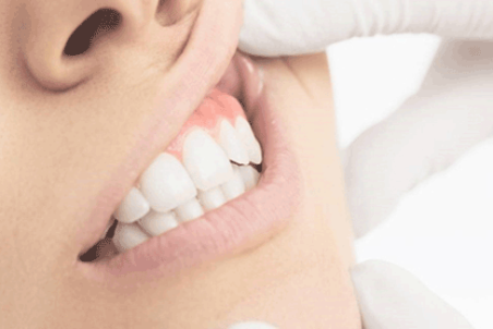 اصلاح طرح لبخند و هرآنچه باید بدانید