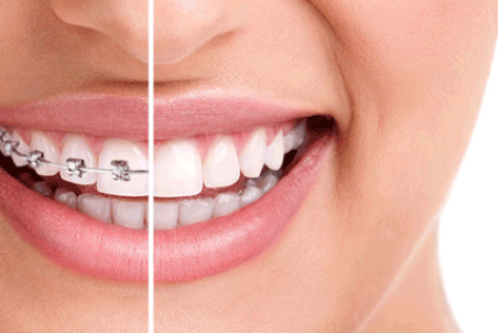 ارتودنسی کوتاه مدت چطور امکان‌پذیر است؟