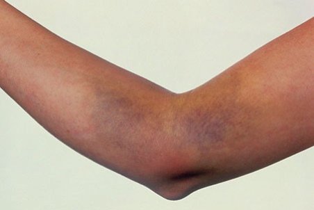 ﻿ چه عواملی باعث کبودی بدون علت بدن می شود؟