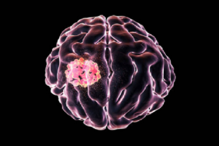 چگونه ابتلای خود به تومور مغزی را تشخیص دهیم؟
