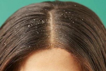 چند راه ساده طب ایرانی برای از بین بردن شوره سر