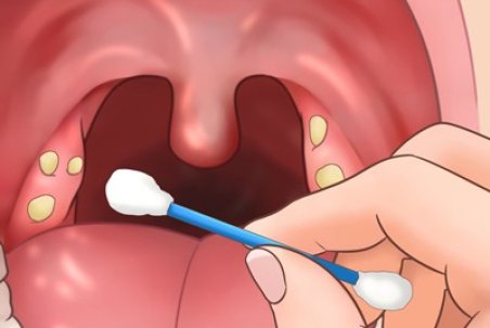 راههای درمان خانگی سنگهای لوزه