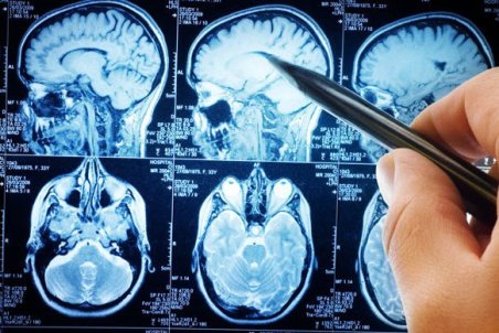 نشانه‌ها و راه‌های پیشگیری از سکته مغزی