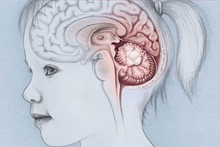 علائم، دلایل، تشخیص و روش درمانی تومور مغزی در کودکان