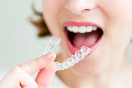 ارتودنسی نامرئی؛ مزایا و قیمت آن