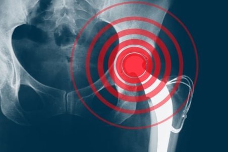 پوکی استخوان در خانم‌ها شایع‌تر است