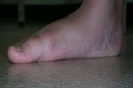 چه راه‌هایی برای اصلاح گودی کف پا وجود دارد؟