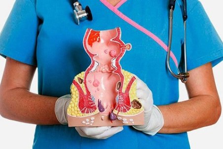 همه چیز درباره بواسیر؛ علت، علائم و درمان