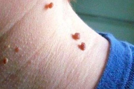 چگونه از شر زگیل‌ها خلاص شویم؟