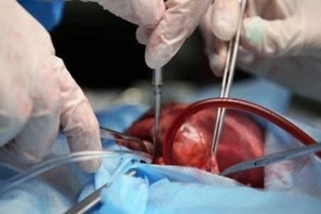 انواع و چگونگی پیوند مغز استخوان