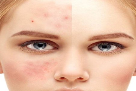 از بین بردن سریع جای جوش صورت