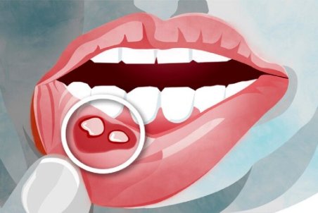 نشانه‌های مشکل دستگاه گوارش در دهان