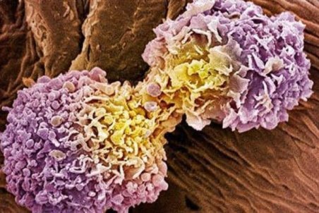 فیبرو کیستیک در زنان چه علایمی دارد؟