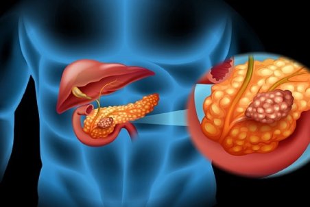 علائم اوليه سرطان لوز المعده چيست؟