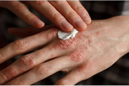 ۶ راهکار ساده برای درمان اگزمای پوستی