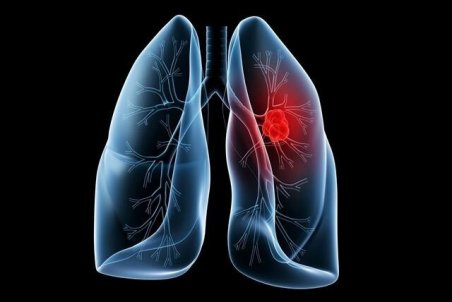 یک بیماری با علائم "مشابه کرونا"، اما کُشنده‌تر!