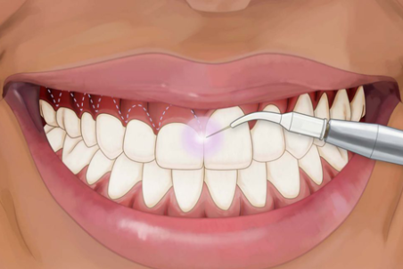 لیفت لثه؛ مزایا و قیمت آن