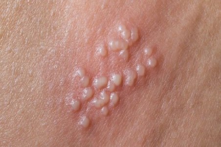 تبخال تناسلی در مردان؛ نشانه ها و علائم