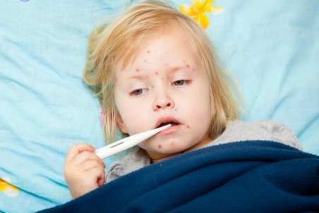 بیماری زونا در کودکان و بررسی علائم و راههای درمان آن