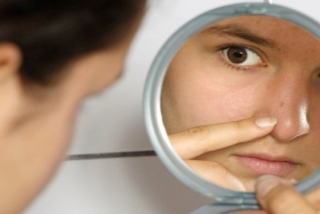 چرا نباید جوش‌های سرسیاه را خالی کرد؟