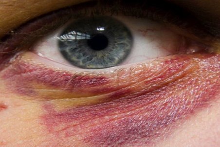 دیه کبودی صورت و اعضای بدن چقدر است؟