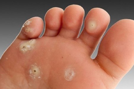 روش‌های گوناگون درمان میخچه