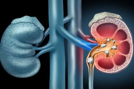 ۳ درمان خانگی برای دفع سنگ کلیه