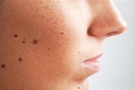 چند درمان خانگی برای از بین بردن خال‌های مزاحم