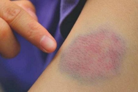 کبودی خارش‌دار؛ از دلایل تا درمان