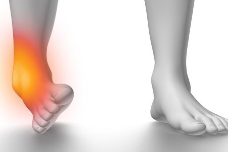 درمان پیچ خوردگی مچ پا با ورزش