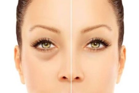 پف زیر چشم چیست و چگونه از شرش خلاص شویم؟