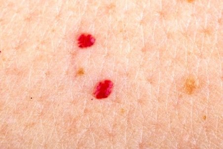 لکه‌های قرمز کوچک روی پوست و دلایل بروز آنها