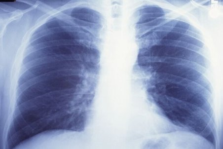 نوعی بیماری کشنده که افراد سیگاری را تهدید میکند