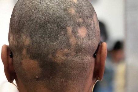 کدام مدل ریزش مو موقتی و برگشت پذیر است؟