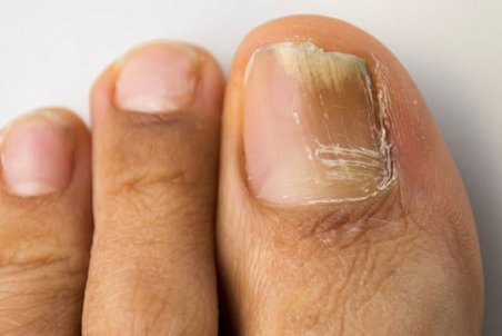 ۶ راهکار خانگی برای درمان قارچ ناخن پا
