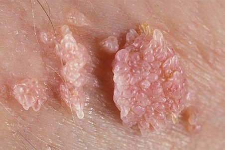 زگیل تناسلی در مردان؛ نشانه‌ها، علل و درمان