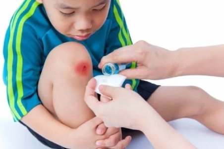 ۱۰ درمان خانگی موثر برای از بین بردن کبودی بدن