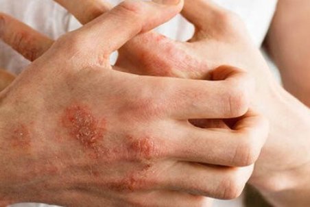علل خارش پوست چیست و چگونه درمان می‌شود؟