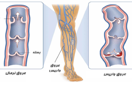 درمان واریس با تغییر سبک زندگی